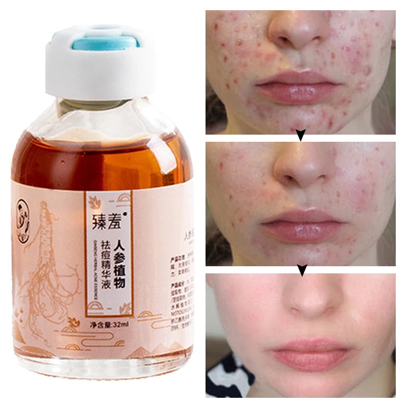 

Acne Treatment Face Serum Nourishment Repair Moisturizing Shrink Pores Acne Facial Serum Korean Skin Care Products 32ml