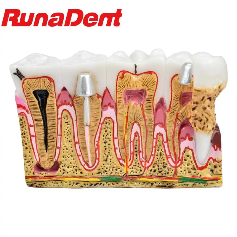 

Dental Caries Anatomy Comprehensive Pathology Nerve for Oral Teaching Teeth Model