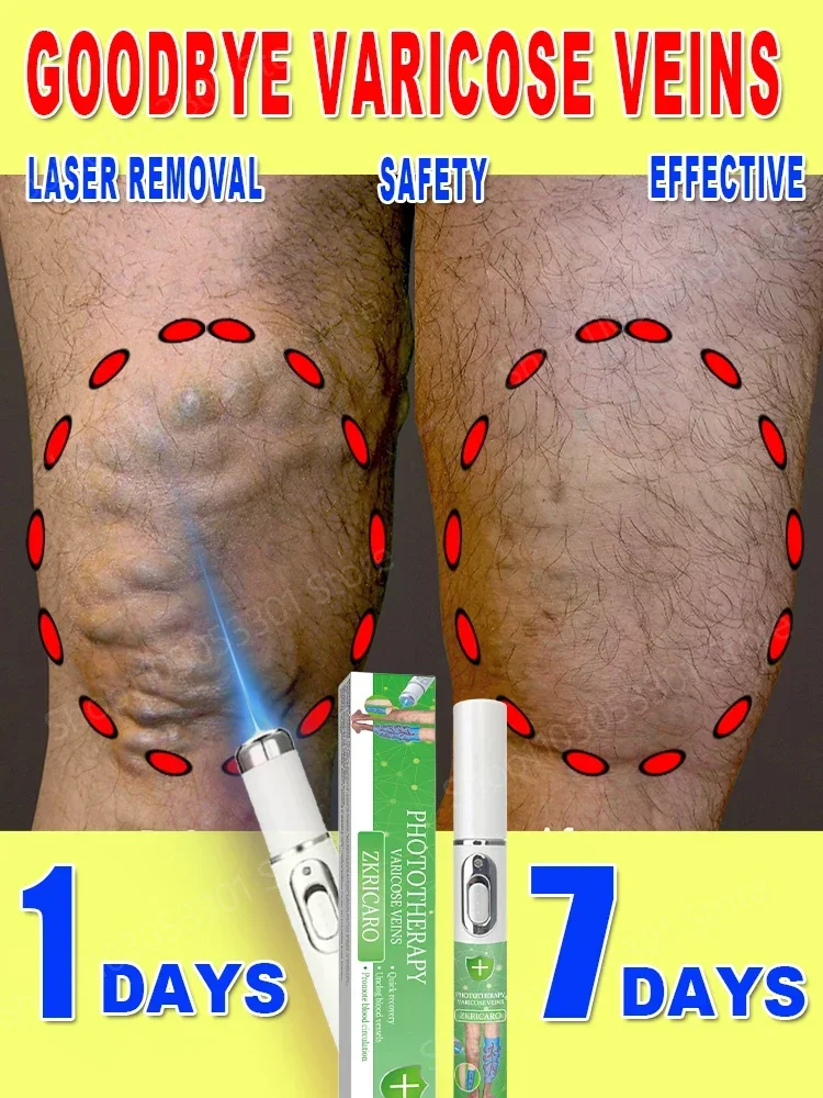 

Powerful Laser Therapy for Moderate Varicose Veins, Relieve Pain and Improve Circulation for Both Men and Women