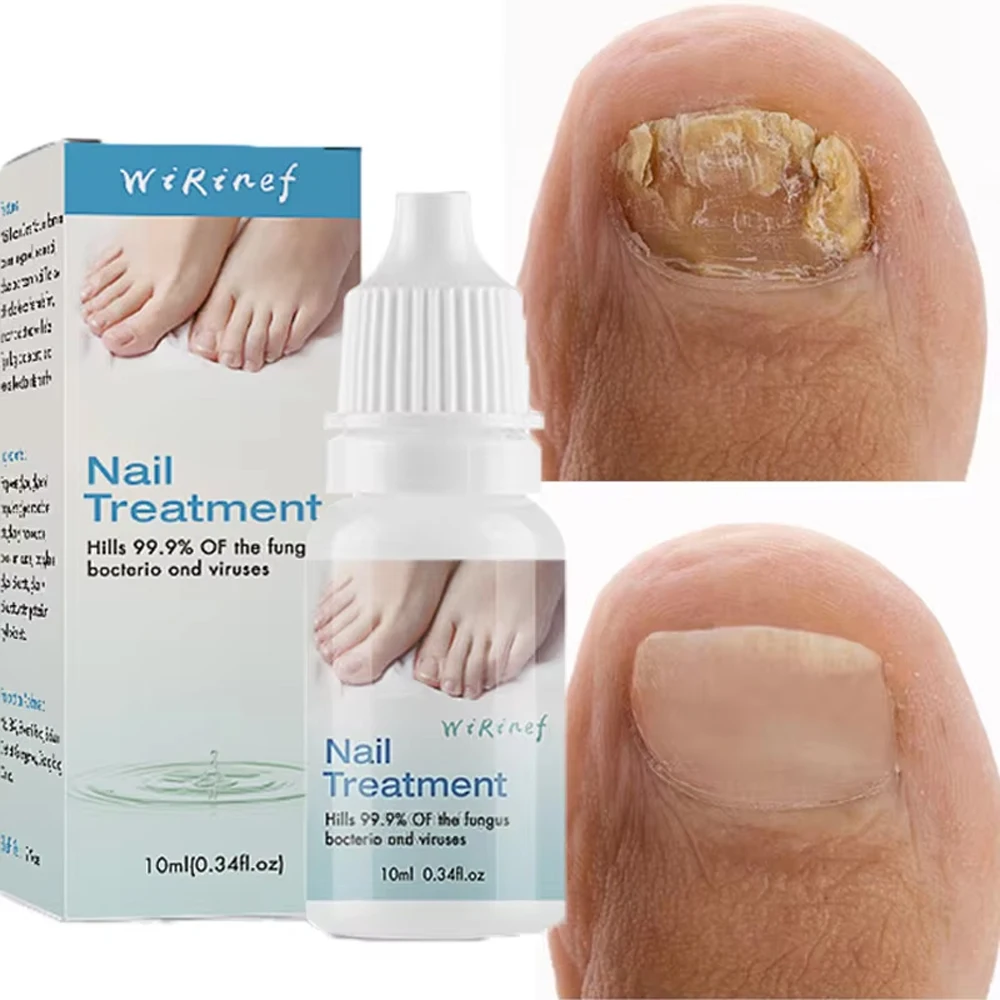 Nail Fungus Treatment Serum Toe Nail Fungus Removal Essence Anti Infection Paronychia Onychomycosis Hand Foot Nail Care Cream