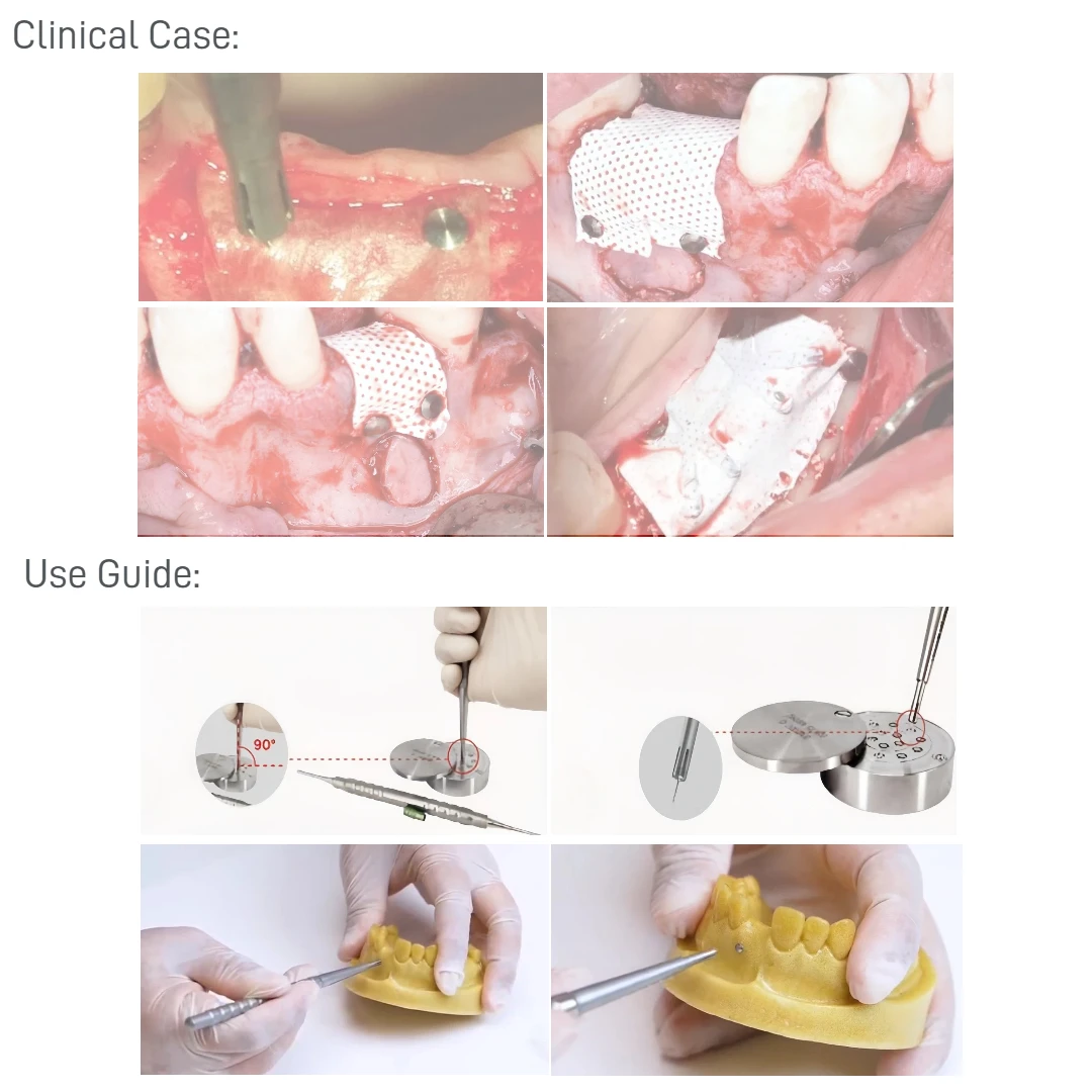 Dental GBR Bone Tack Membrane Fixation Tac Kit Titanium Driver Pin Case Alloy Fixation Stabilization Flat Headed Nail 3.75mm 5mm