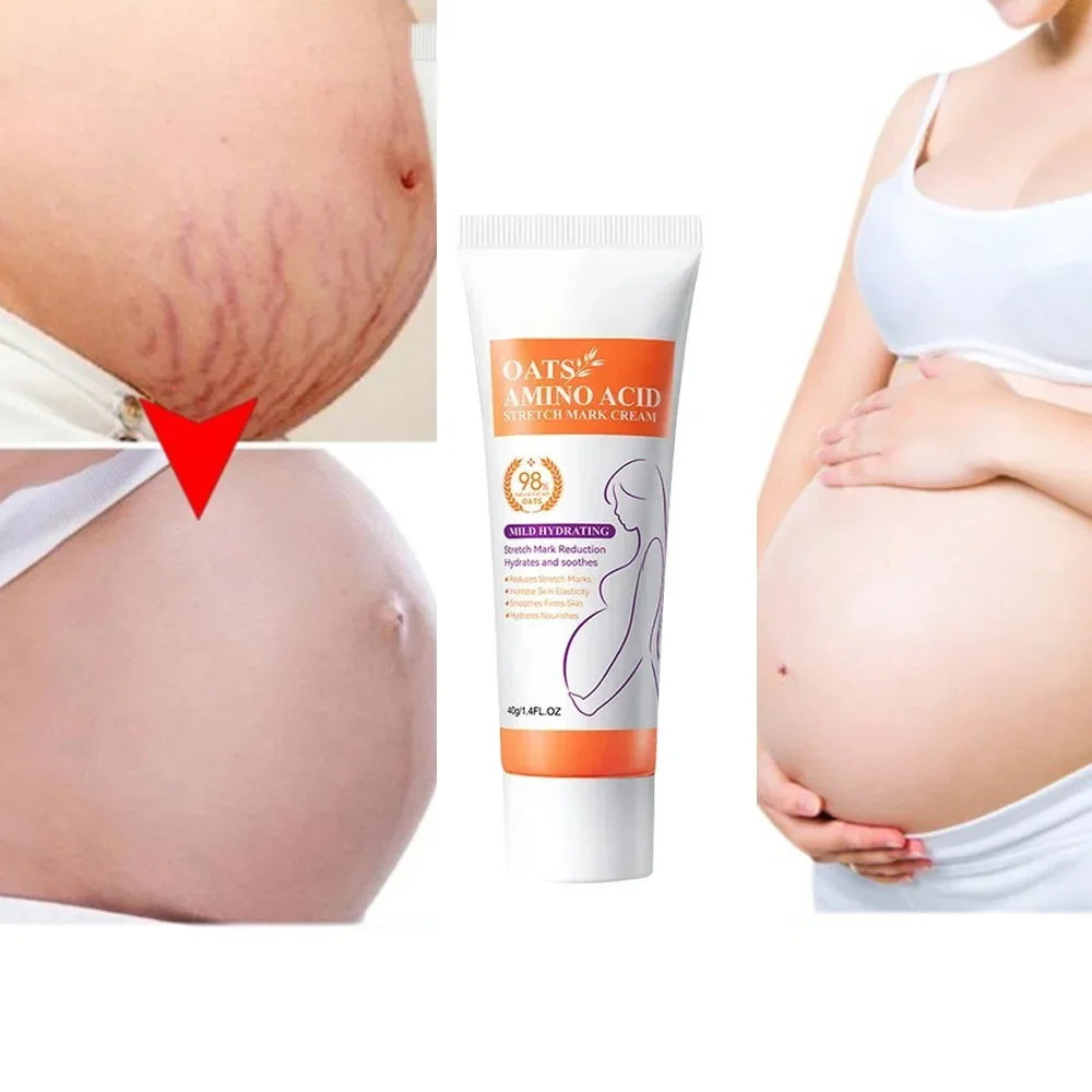 Stretch Marks Repair Essential Oil Skin Care Treatment Cream For Maternity Remover Anti-Wrinkle Slackline For Pregnant