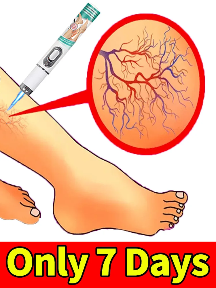 

Restore leg health in 7 days and stop varicose veins from recurring