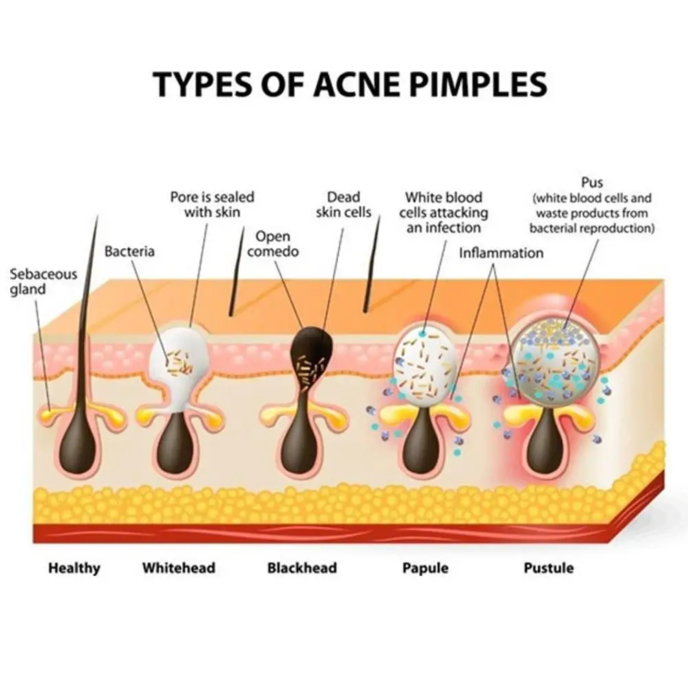 5 Stks/partij Mee-Eter Verwijderaar Neusvlek Diepe Reiniging Huidverzorging Krimpen Poriën Acne Behandeling Neusmasker Zwarte Dot Poriën Schone Strip