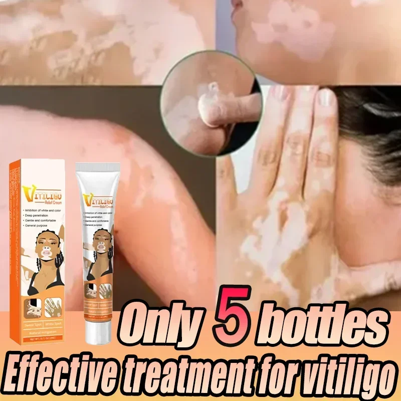 [New] Vitiligo Cream Vitiligo Remover Tinea Versicolor Body Lotion Helps Get Rid of Sweat Spot Vitiligo, Skin Vitiligo Clear