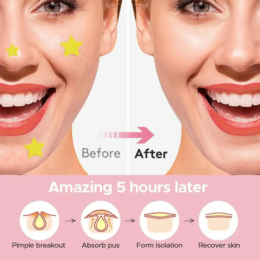 600 PCS Star Acne Patch Mild ไม่ระคายเคือง Lightens Acne Hydrocolloid สิวสติกเกอร์สําหรับสิวหัวดําปิด Comedones ฝาครอบ