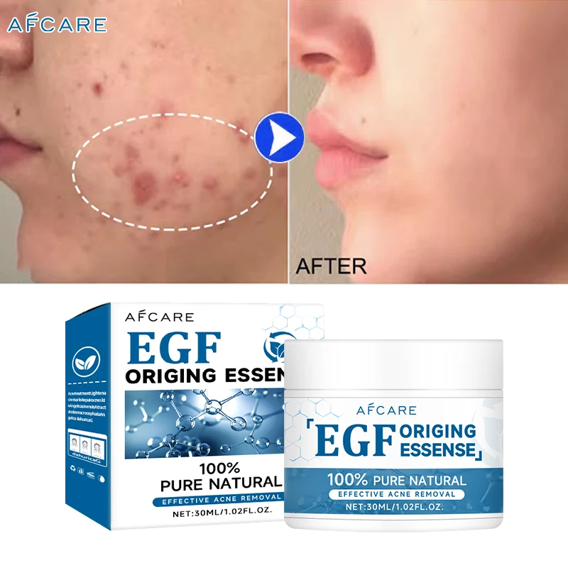 Oligopeptides Acne Treatment Cream Repair Pimple Spots Deep Cleaning Pore Shrinking Anti-acne Oil Control Moisturizer Skin Care