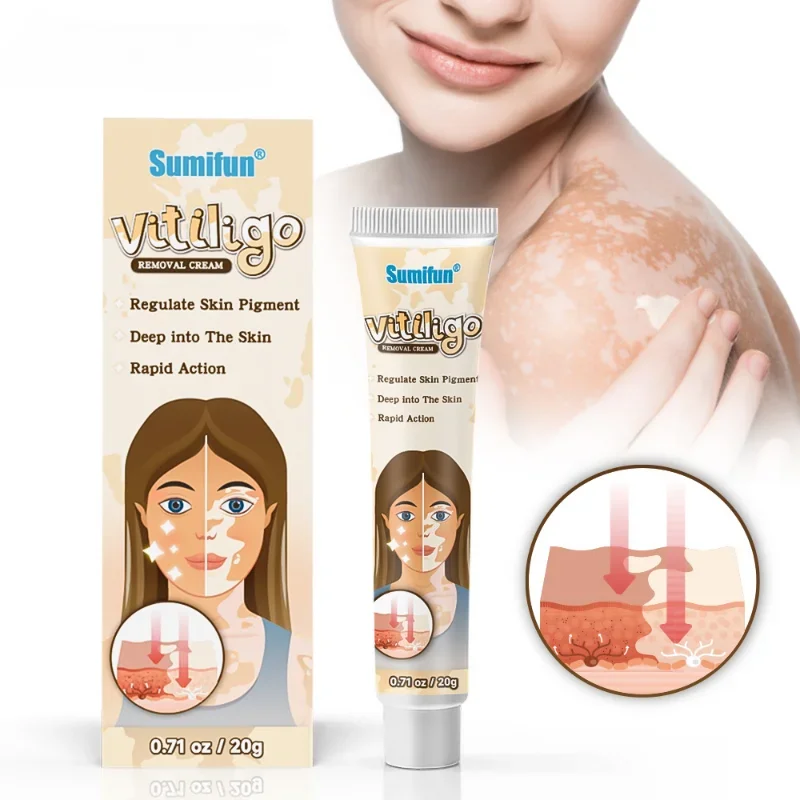 Vitiligo Cream Reduce White Spots Melanin Deposits Repair Skin Leukoplakia Disease Relieve Skin Itch Herbal Ointment Care 20g