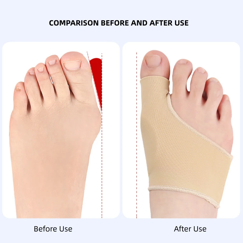 1Pair Gel Forefoot Pedicure Socks Big Feet Hallux Valgus Protector Insoles Toe Corrector Straightener Bunions Pain Relieve