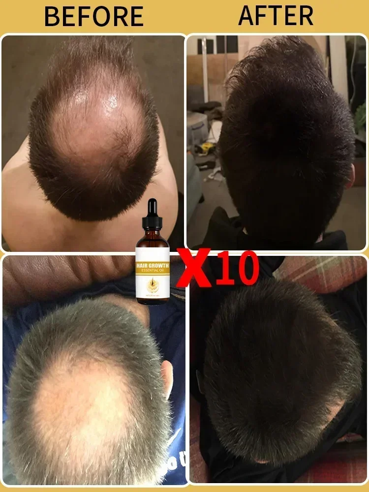 Óleo De Crescimento De Cabelo Para Homens, Biotina Tratamento Rápido, Soro De Calvície