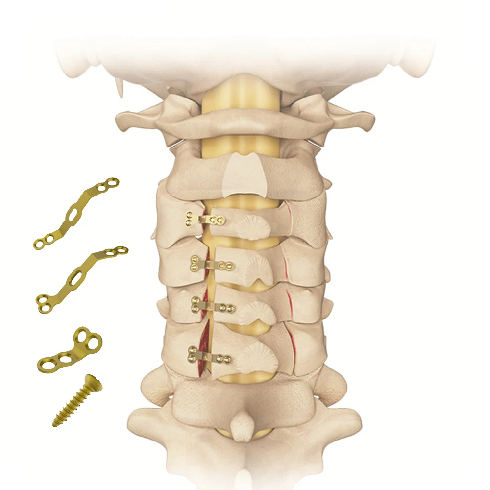 Laminoplasty Fixation System CanPCP, spine surgery screw titanium