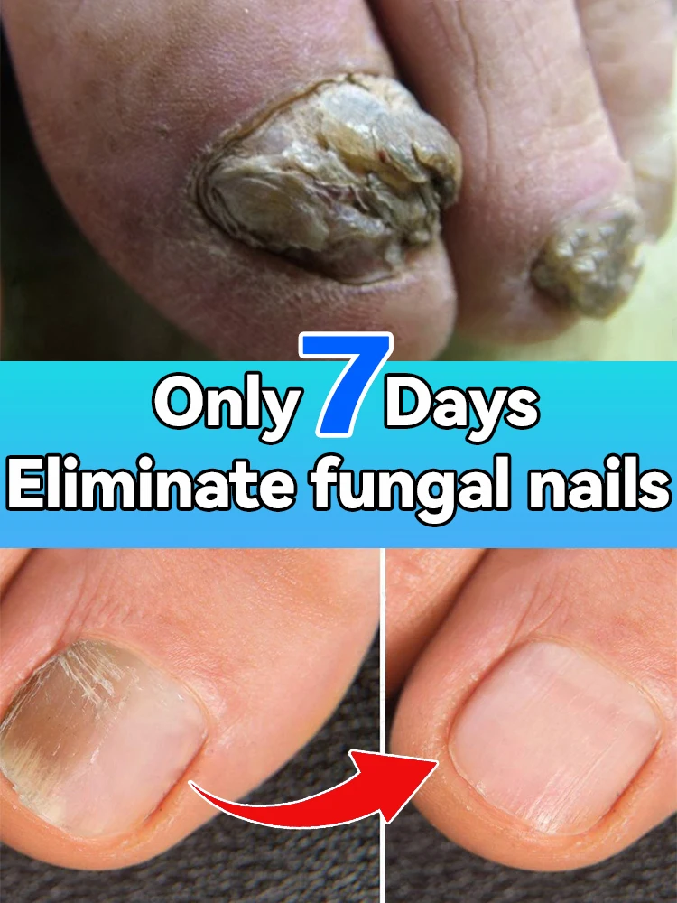 Highly effective repair of Foot nails