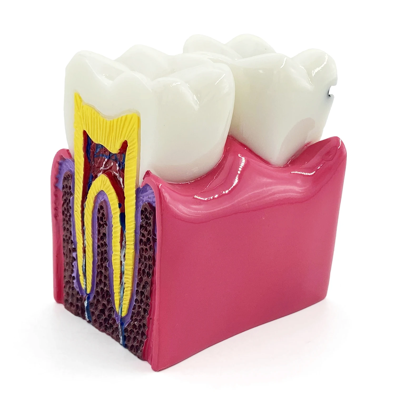 WellCK Dental Materials Lab Teeth Model 6 Times Caries Comparation Study Models For Dentist Studying and Researching
