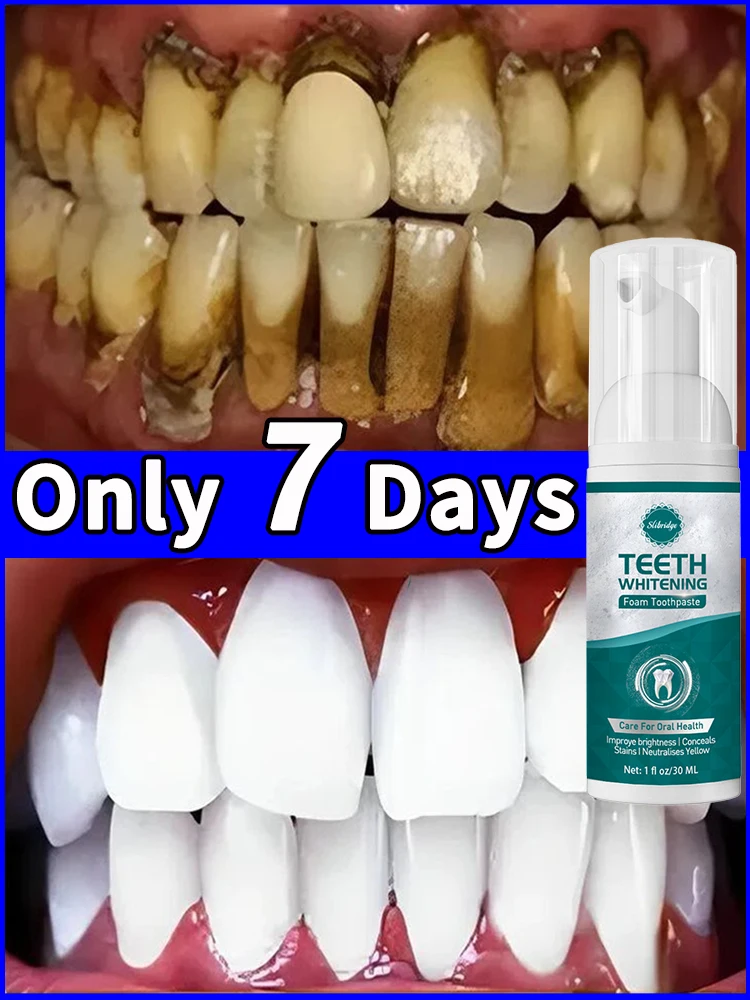 Tartar removers dissolve tartar and remove stains in 2025