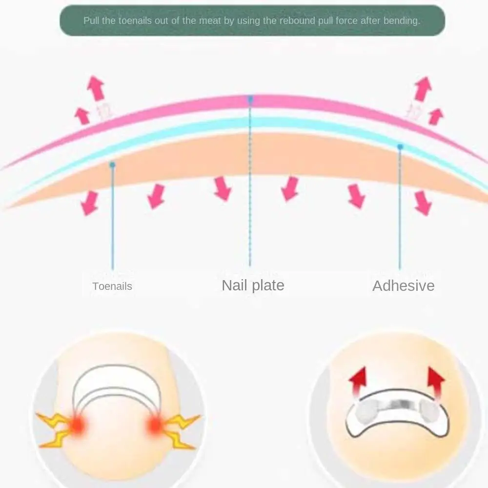 Ingrown Toenail Recover Toe Braces Pedicure Tool Bunion Corrector Ingrown Toenails Corrector Toenail Straightener Toenail Fixer