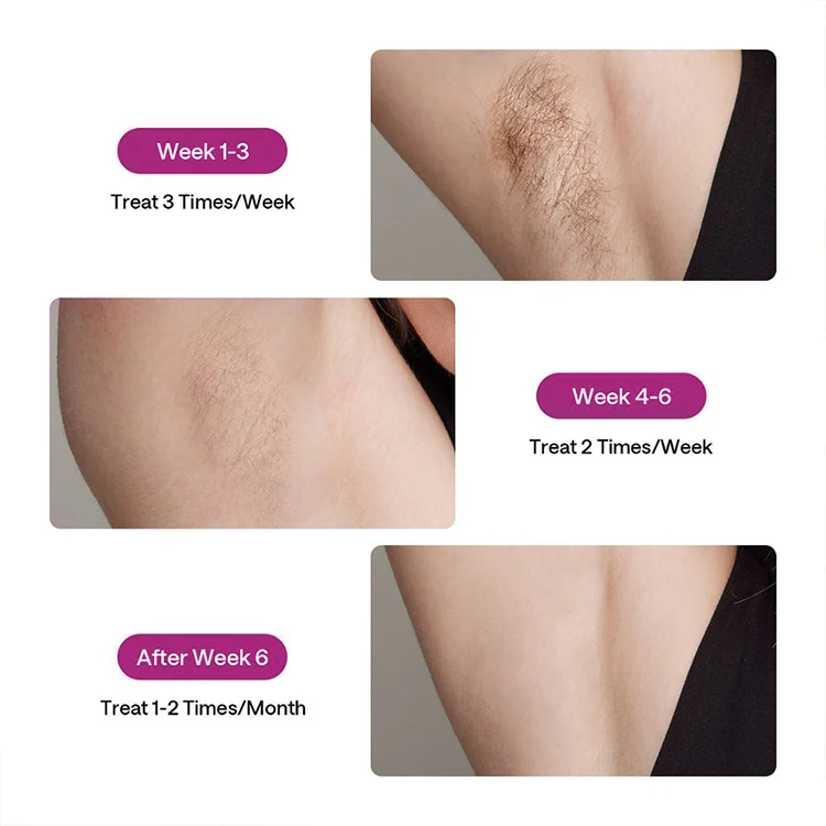 2X 24J تنظيف الشعر الدائم النساء إزالة الحلاقة الشعر الجسم نظيفة بيكيني خط الياقوت الجليد التبريد إزالة الشعر IPL الدائم