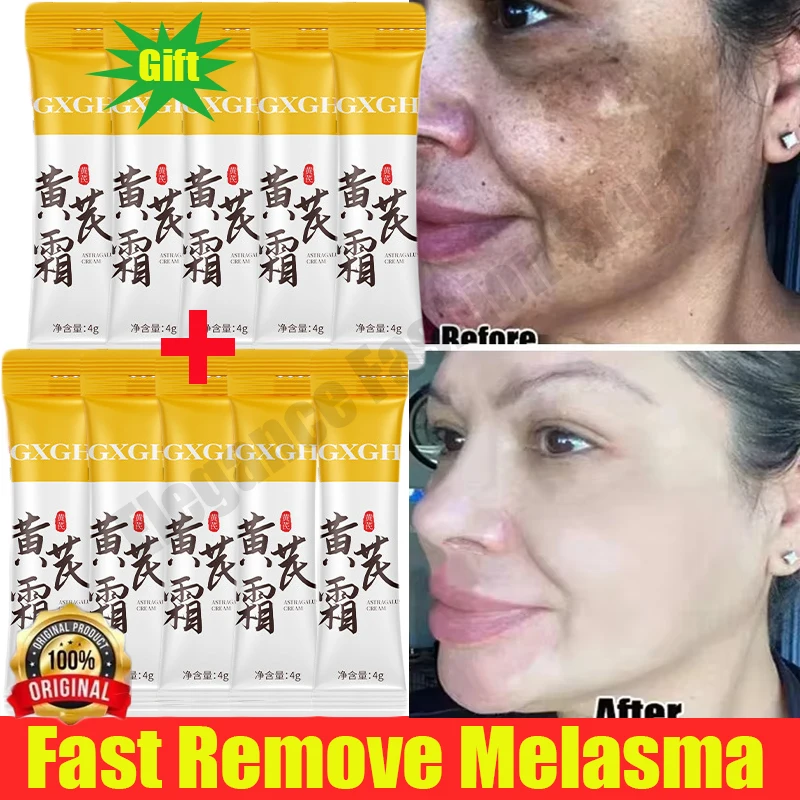 

Powerful Spot-removing Whiten Cream Brighten Skin Fast Eliminates Melanin Pigmentation Melasma Dark Spots Korean Skin Care