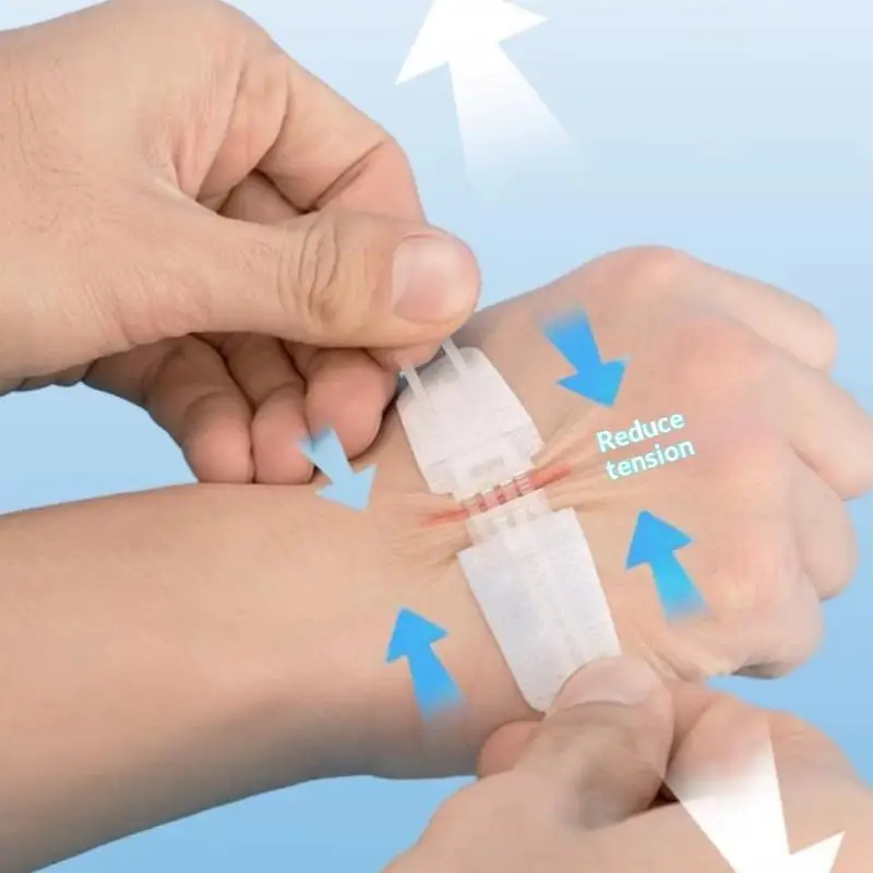 Zipper Band-aid Painless Wound Closure Device Suture-free Wound Dressing Patches Zip Suture Reducer Band Aid Outdoor Portable