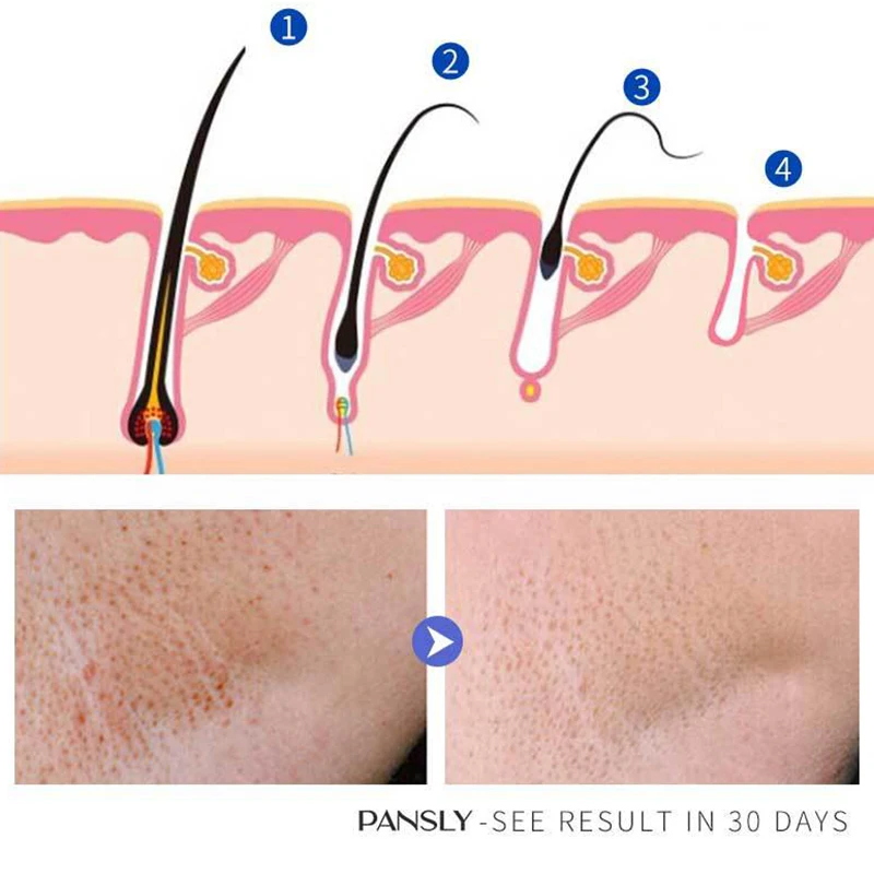 Inhibidor de eliminación de vello, Barba, Bikini, piernas íntimas, cuerpo, axila, lotioina, suaviza la piel, depilación indolora, permanente