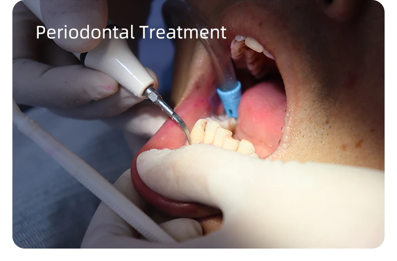 VVDental Ultraschall-Scaler-Maschine mit LED-Licht zur Entfernung von Zahnbelägen und Zahnstein, Reinigung der Zähne, Zahnaufhellungswerkzeuge für die Zahnmedizin – Detail 21