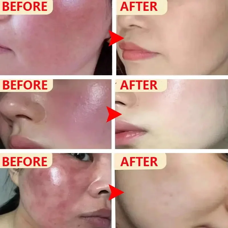 New Facial Redness Repair Cream Improve Rosacea Sooth Dry Sensitive Itchy Skin Repair Barrier Moisturize Lotion Korean Cosmetics