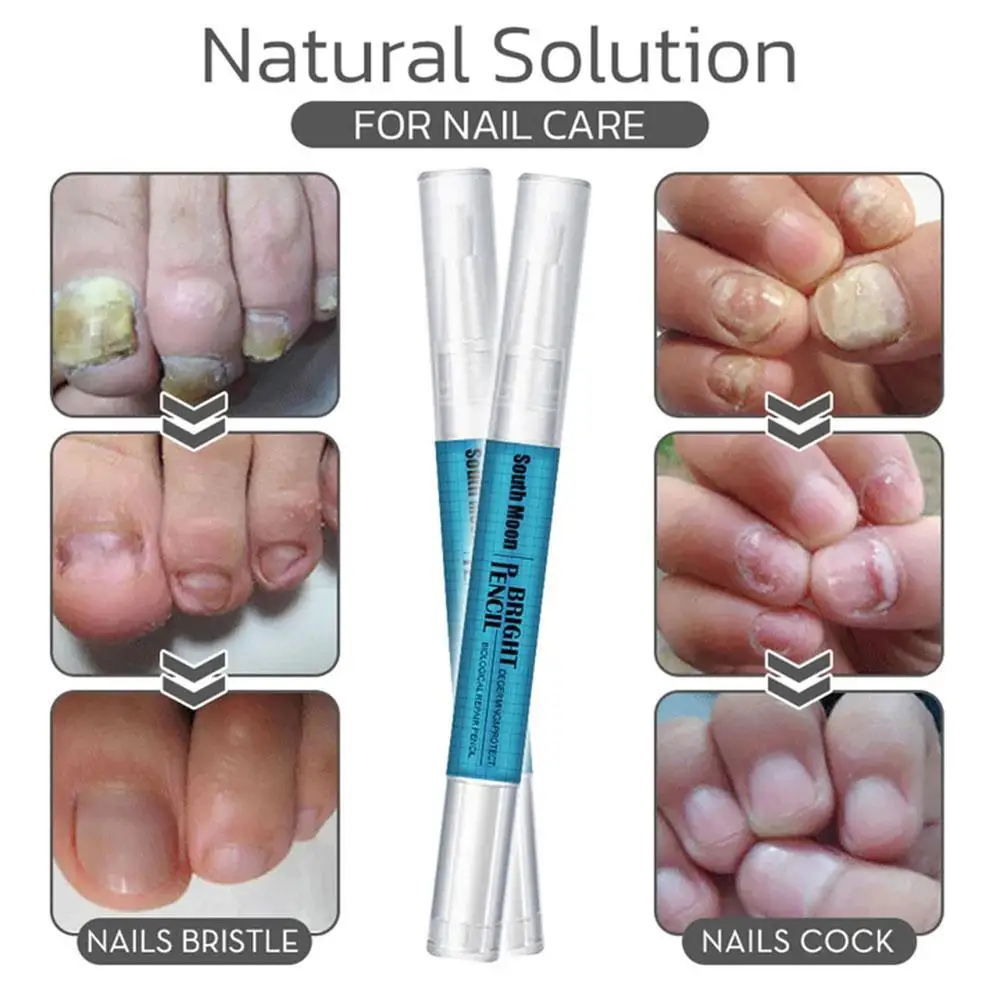 Onychomycosis Repair Liquid Pen Paronychia Nail Cure Yellowing Toenail Treatment Serum Anti-Infective Cracking Fungal Remov U7Q1