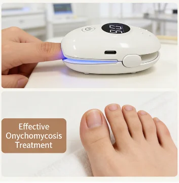 Nail Fungus Laser Treatment Device – Effectively Remove Toenail Fingernail Fungus, Onychomycosis Therapy Cure Machine Repair