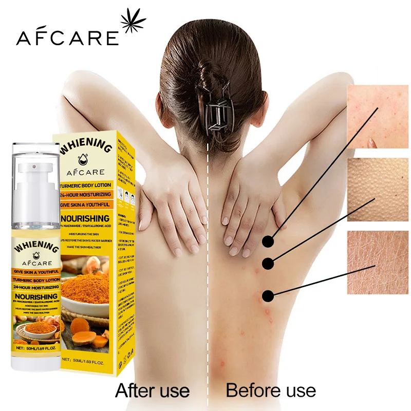 Turmeric Body Cream Chicken Skin Removal Treatment Keratosis Pilaris Lotion Rough Bumpy Moisturizer Whitening Creams