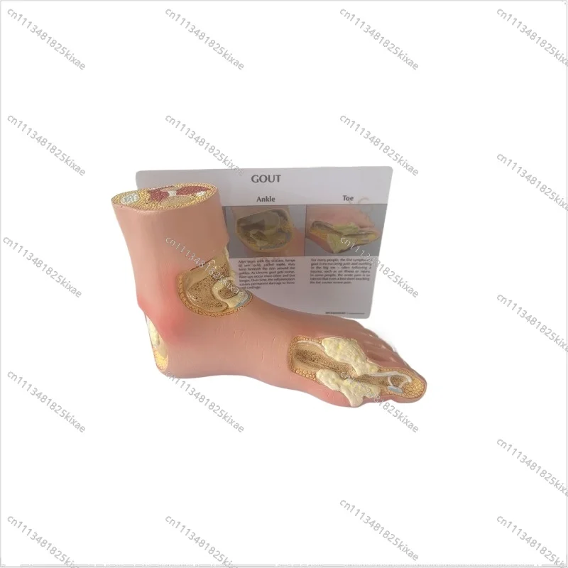 For Foot Gout Stone Foot Model, Gout Stone  Model, Rheumatic Joint, Dissolving Stone  Anatomical  Muscle