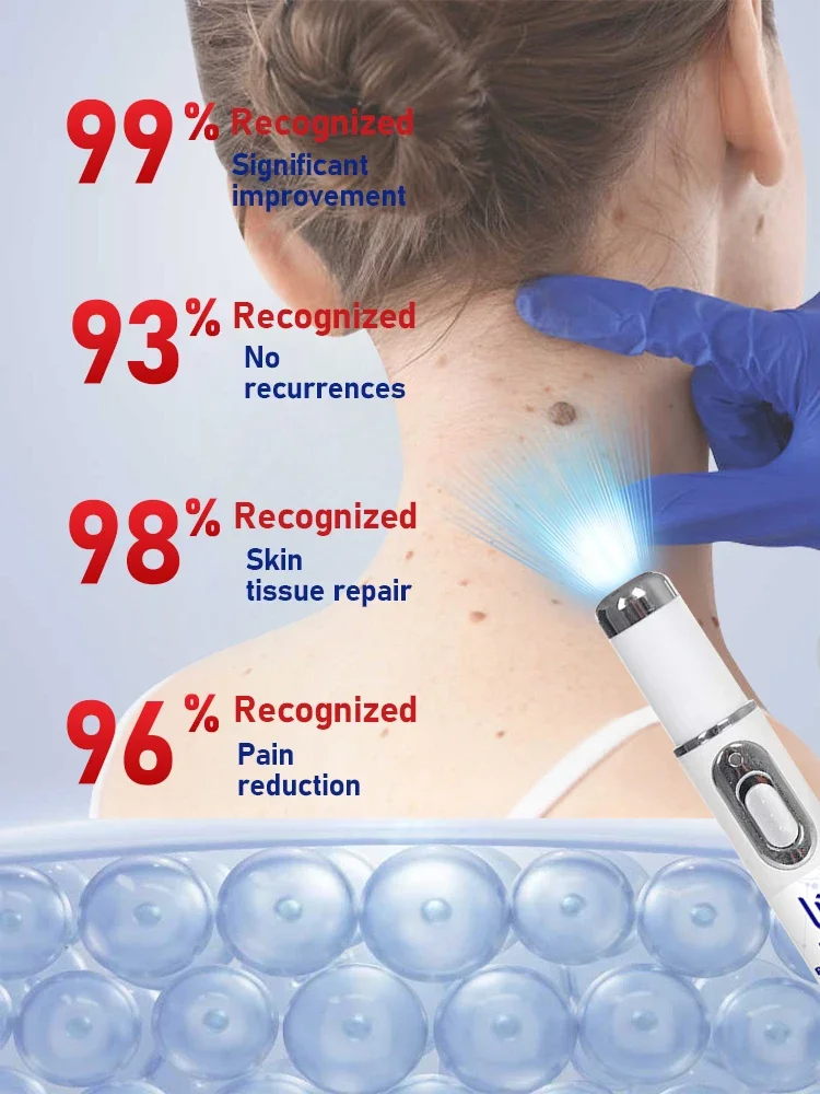 Penna a luce blu di vendita calda per risolvere le verruche del corpo, strumenti per la cura delle verruche