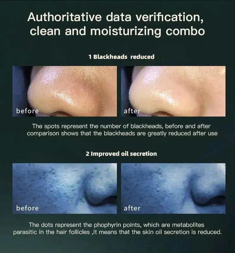 أداة حقن الأكسجين ذات الفقاعات الصغيرة هيدرا جلدي أداة تجميل لتنظيف الرؤوس السوداء