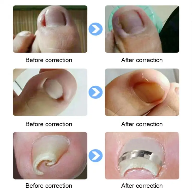 내성발톱 교정 교정기 키트, 전문 발톱 케어, 페디큐어 매니큐어 클리퍼 픽서, Corr 복구, 1 개, 3 개, 5 개, 10 개