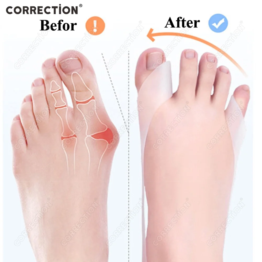 תיקון סיליקון גדול & קטן אצבע הבוהן מגן הבוהן מפרידי אלונקות מחליק פיקה מגן כאב הקלה רגל טיפול