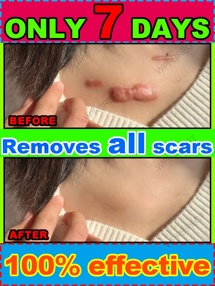 

Don't let scars define you! Use this to reshape your skin into a smooth and beautiful one