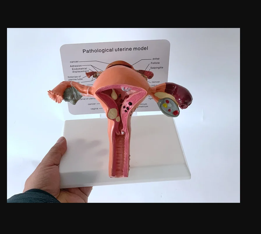 

Medical Teaching props model Human Female Pathological Uterus Ovary Model Anatomical Disease Pathology Medical @Zeyasen