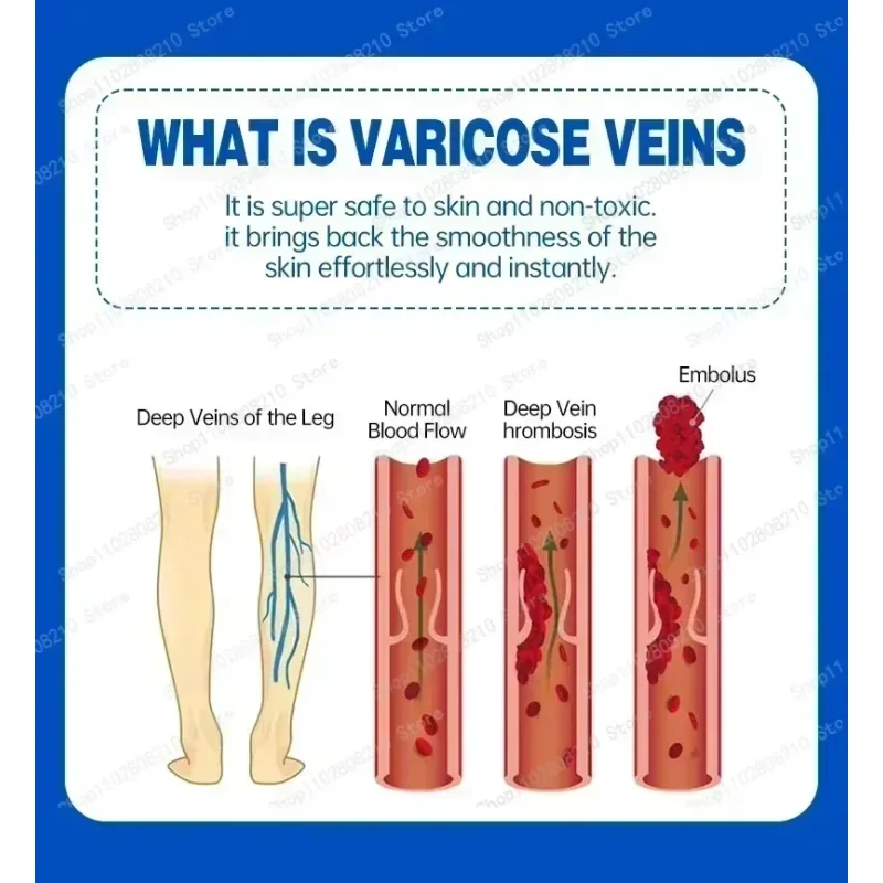 Cream leg skin irritates and soothes venous tension