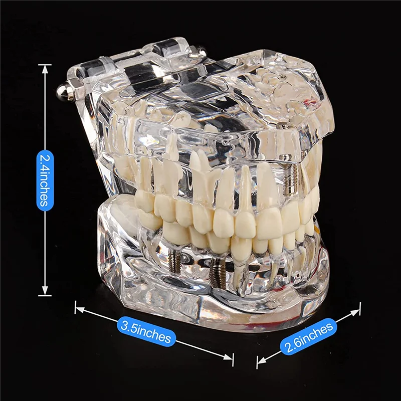 Modello di denti per malattie trasparenti con ponte per impianto dentale, modello dentale per l'educazione del paziente e degli studenti odontotecnici