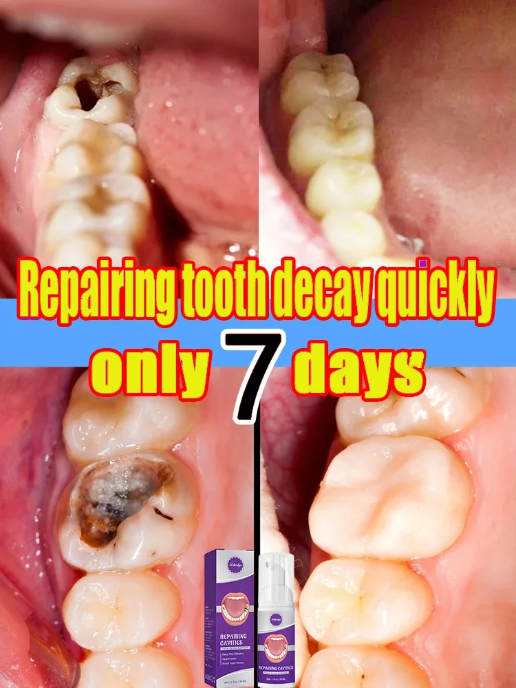 Decay tooth Cavities healing anti caries