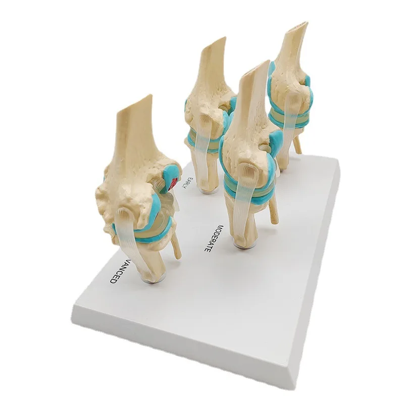 Four-stage Human Pathological Knee Joint Anatomy Model Medical Science Teaching Resources Dropshipping