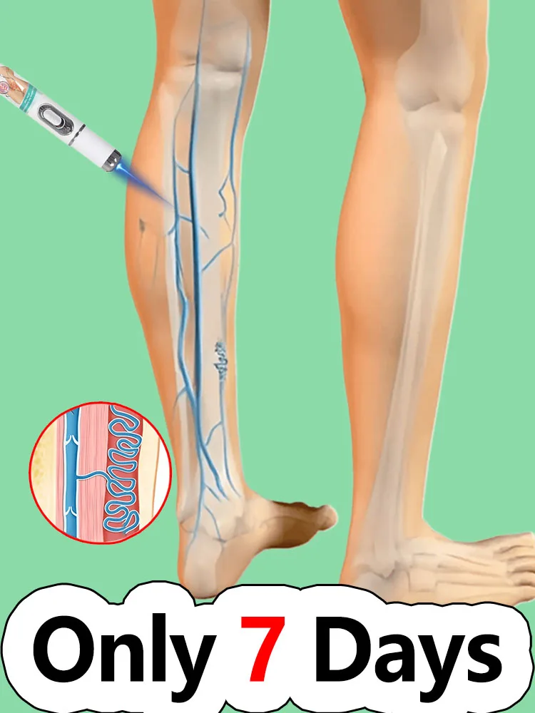 

blue light pen solve varicose veins,leg care tools Say goodbye to leg discomfort Spider Legs 2 minutes a day, no more worries