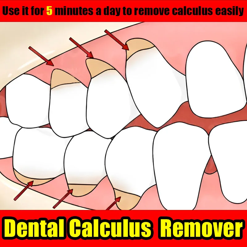 

Toothpaste Whitening Remove Dental Calculus