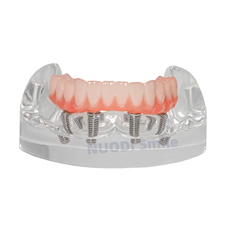 Dental Lower Jaw Restoration Implant Model All-on-4 Overdenture Implant Teeth Model 4 Removable Screws with Post Core Bridge