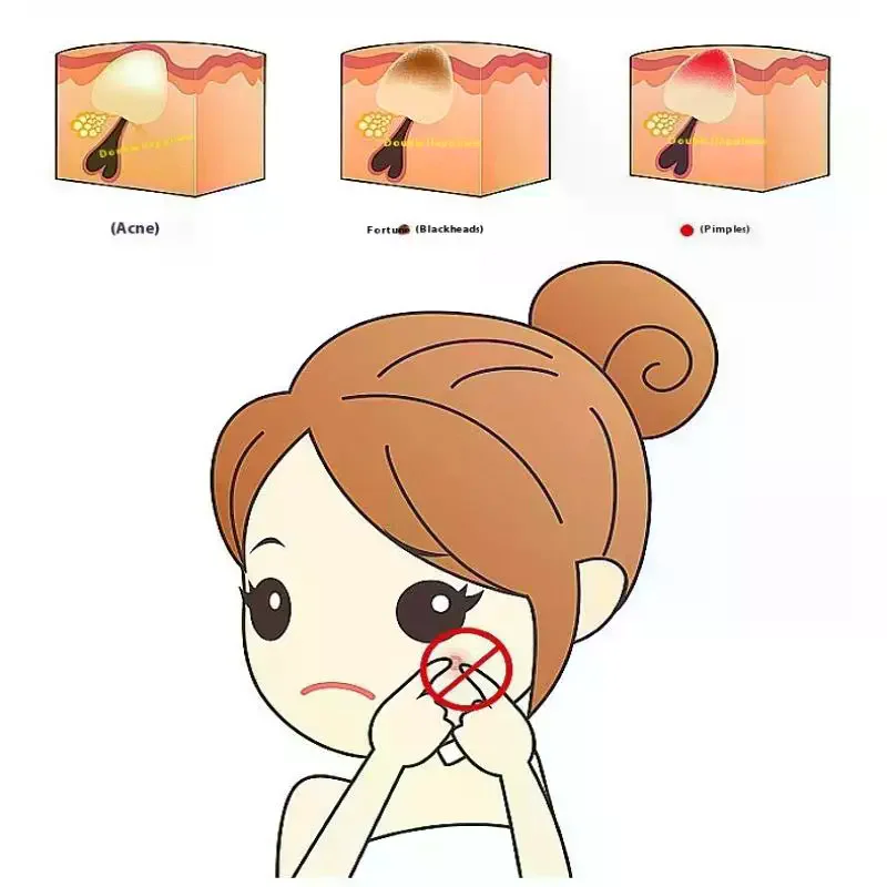 Acne Blackhead Tweezers 7-Shaped Hook Clip Facial Beauty Remove Acne Needle Tools For Skin Care