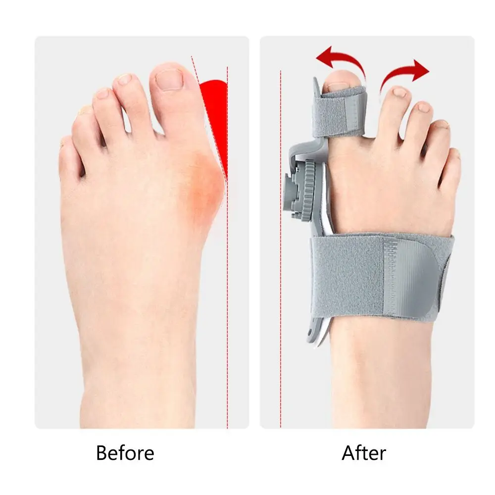 Useful Adjustable Toe Corrector Hallux Valgus Rotatable Bunion Corrector Pedicure Foot Care Orthopedic Supplies Foot