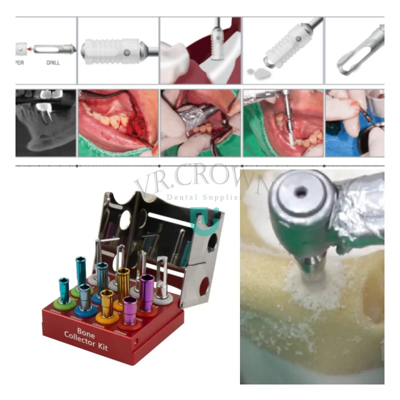 Dental Implant Surgical Bone Collector Bone Chip Maker Drill & Stopper Kit Stainless Steel 12 Pcs CE Bone Collector Kit