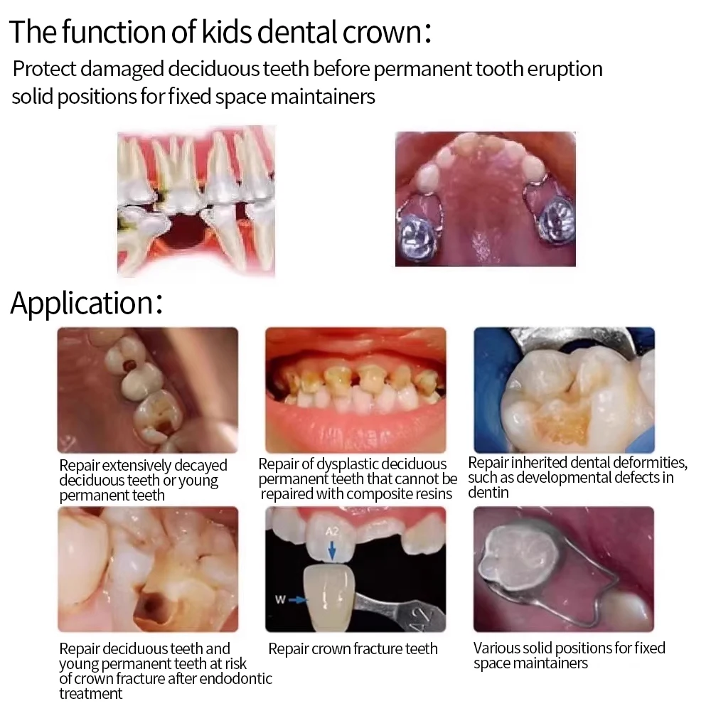 5 ชิ้น/กล่องเด็กมงกุฎสแตนเลสหลัก Molar Crown Preformed มงกุฎโลหะกล่องแพคเกจ