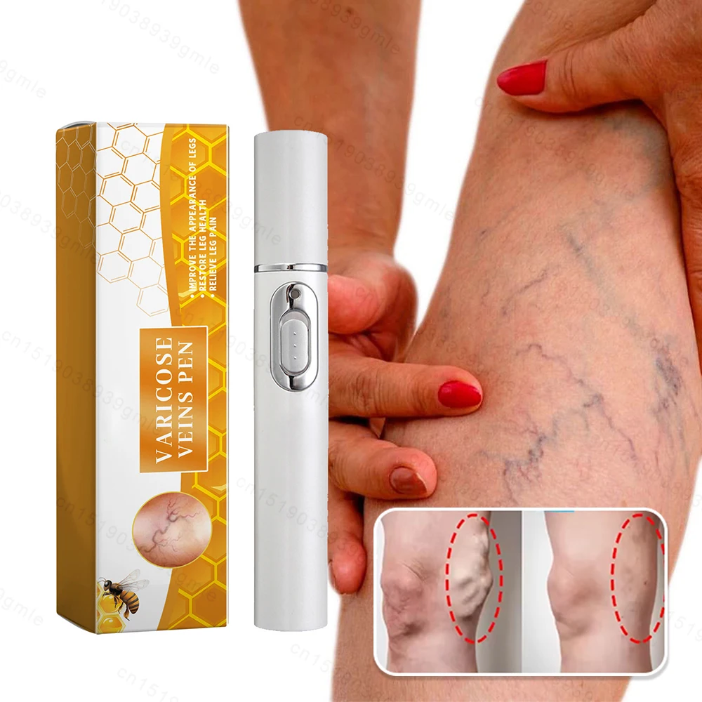 

Абажур для лечения варикозного расширения вен, ручка для ремонта ног, улучшение кровообращения, облегчение, расширенный васкулит, продукт для ухода за флебитом ног