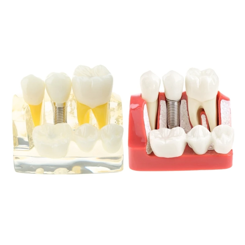 

4 Implant Teeth Model Analysis Bridge Demonstration Model Dental Teeth Roots Removable Drop Shipping