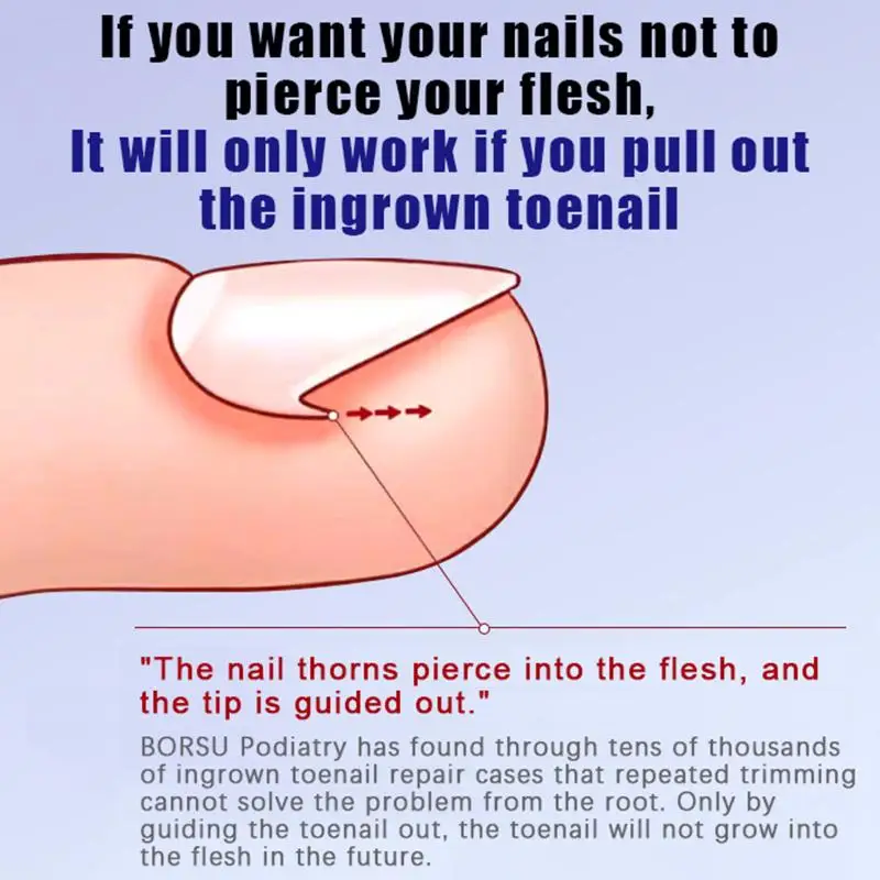 X-shaped Ingrown Toenail Correction Tool Ingrown Toenail Treatments Elastic Patch Sticker Toenail Straightening Pedicure Tool