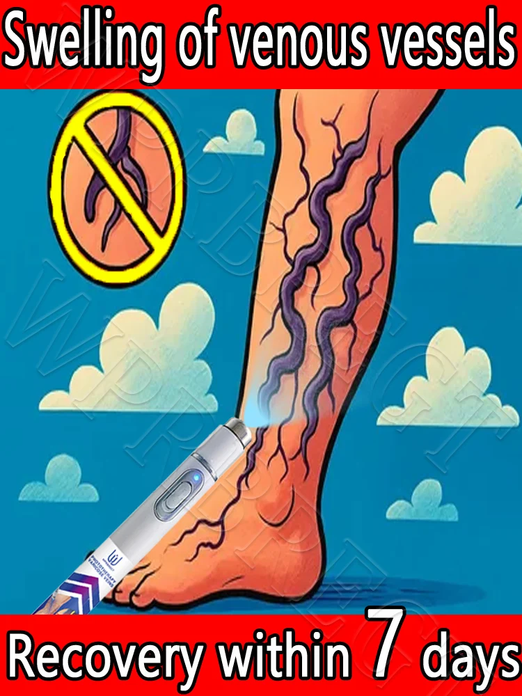 

Эффективное лечение варикозного расширения вен, внутривенный лазер, проблемы варикозного расширения вен.